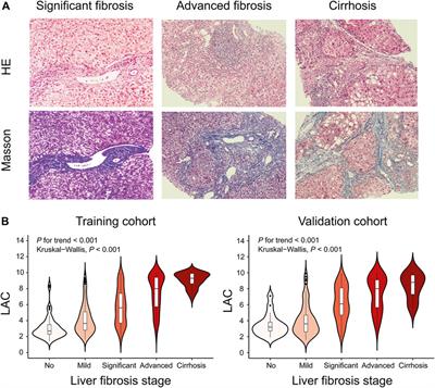 The LAC Score Indicates Significant Fibrosis in Patients With Chronic Drug-Induced Liver Injury: A Large Biopsy-Based Study